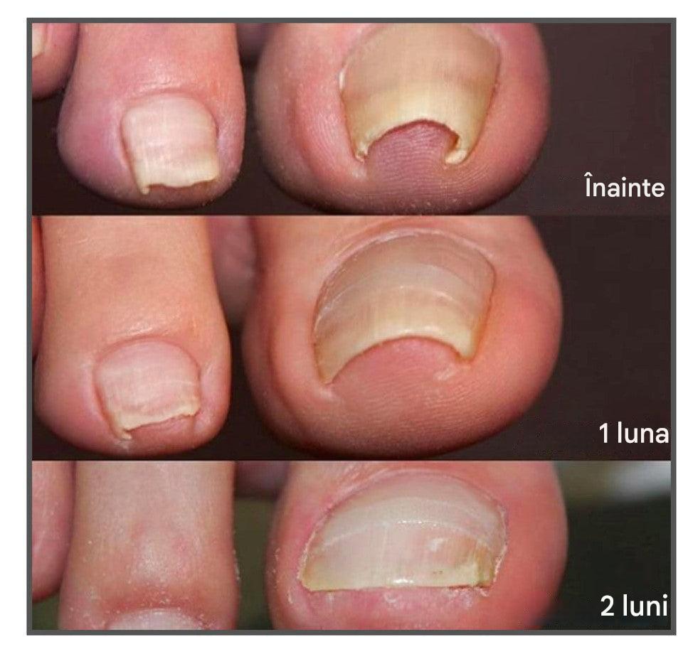ToeFix+ Petice pentru unghii | Scapă de unghiile învinețite!